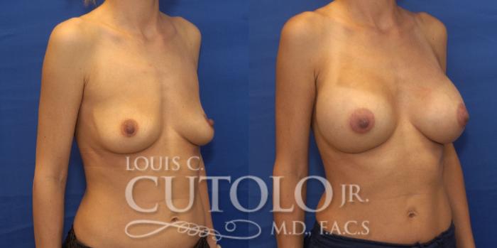 Before & After Breast Augmentation Case 241 Right Oblique View in Brooklyn, Staten Island, Queens, NY