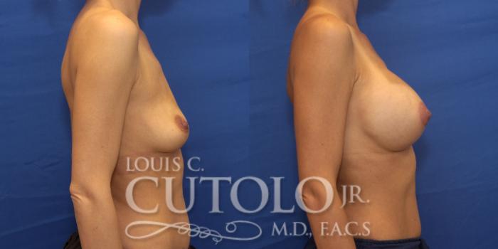 Before & After Breast Augmentation Case 241 Right Side View in Brooklyn, Staten Island, Queens, NY