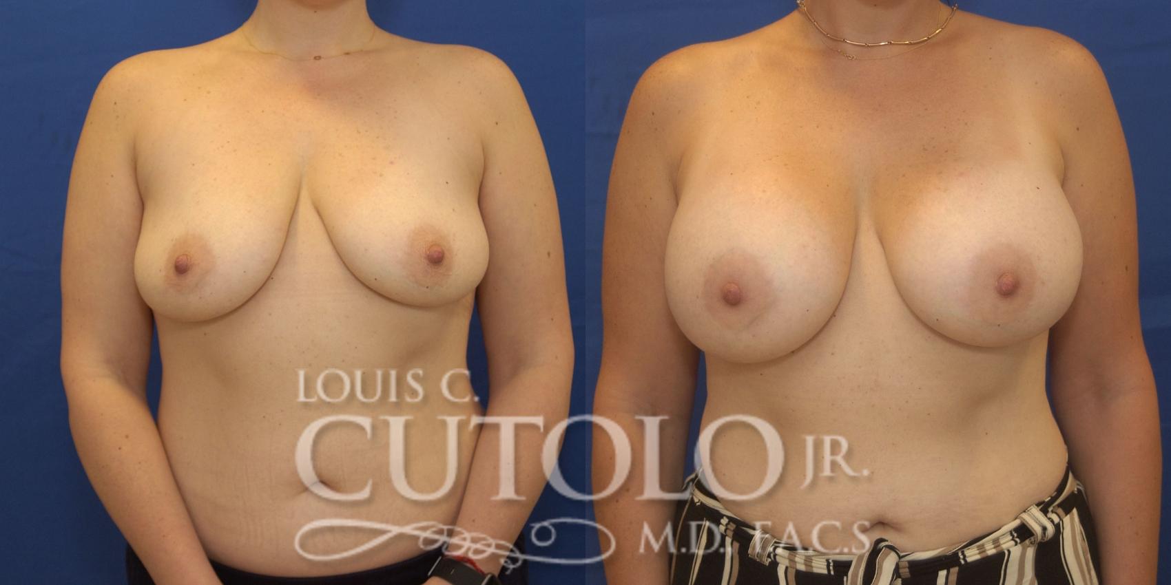 Before & After Breast Augmentation Case 246 Front View in Brooklyn, Staten Island, Queens, NY