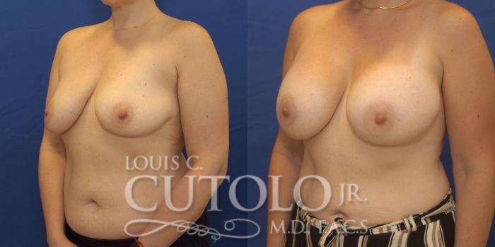 Before & After Breast Augmentation Case 246 Left Oblique View in Brooklyn, Staten Island, Queens, NY