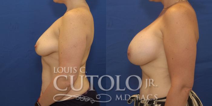 Before & After Breast Augmentation Case 246 Left Side View in Brooklyn, Staten Island, Queens, NY