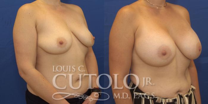 Before & After Breast Augmentation Case 246 Right Oblique View in Brooklyn, Staten Island, Queens, NY