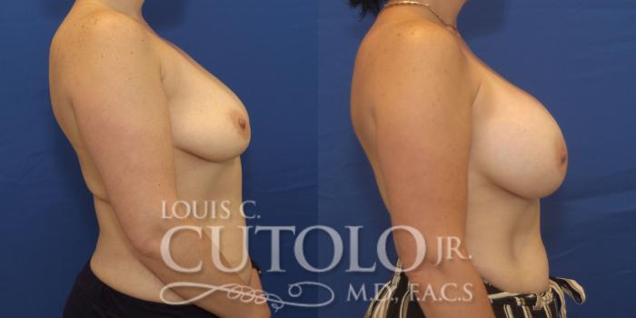 Before & After Breast Augmentation Case 246 Right Side View in Brooklyn, Staten Island, Queens, NY