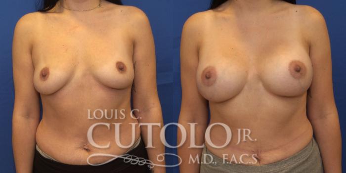 Before & After Breast Augmentation Case 251 Front View in Brooklyn, Staten Island, Queens, NY