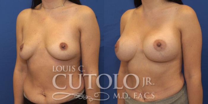 Before & After Breast Augmentation Case 251 Left Oblique View in Brooklyn, Staten Island, Queens, NY