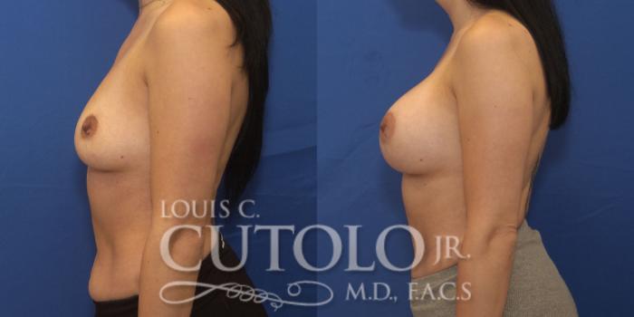 Before & After Breast Augmentation Case 251 Left Side View in Brooklyn, Staten Island, Queens, NY