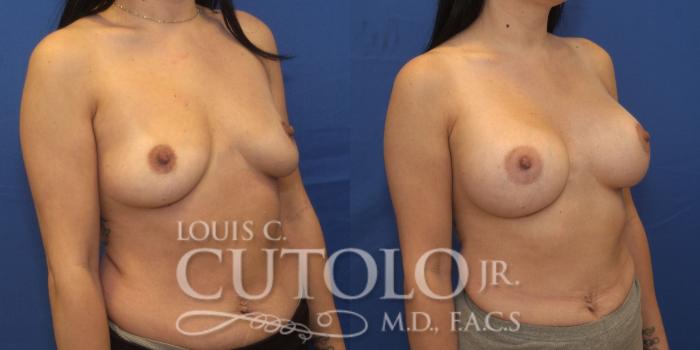 Before & After Breast Augmentation Case 251 Right Oblique View in Brooklyn, Staten Island, Queens, NY