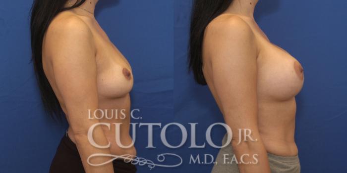 Before & After Breast Augmentation Case 251 Right Side View in Brooklyn, Staten Island, Queens, NY