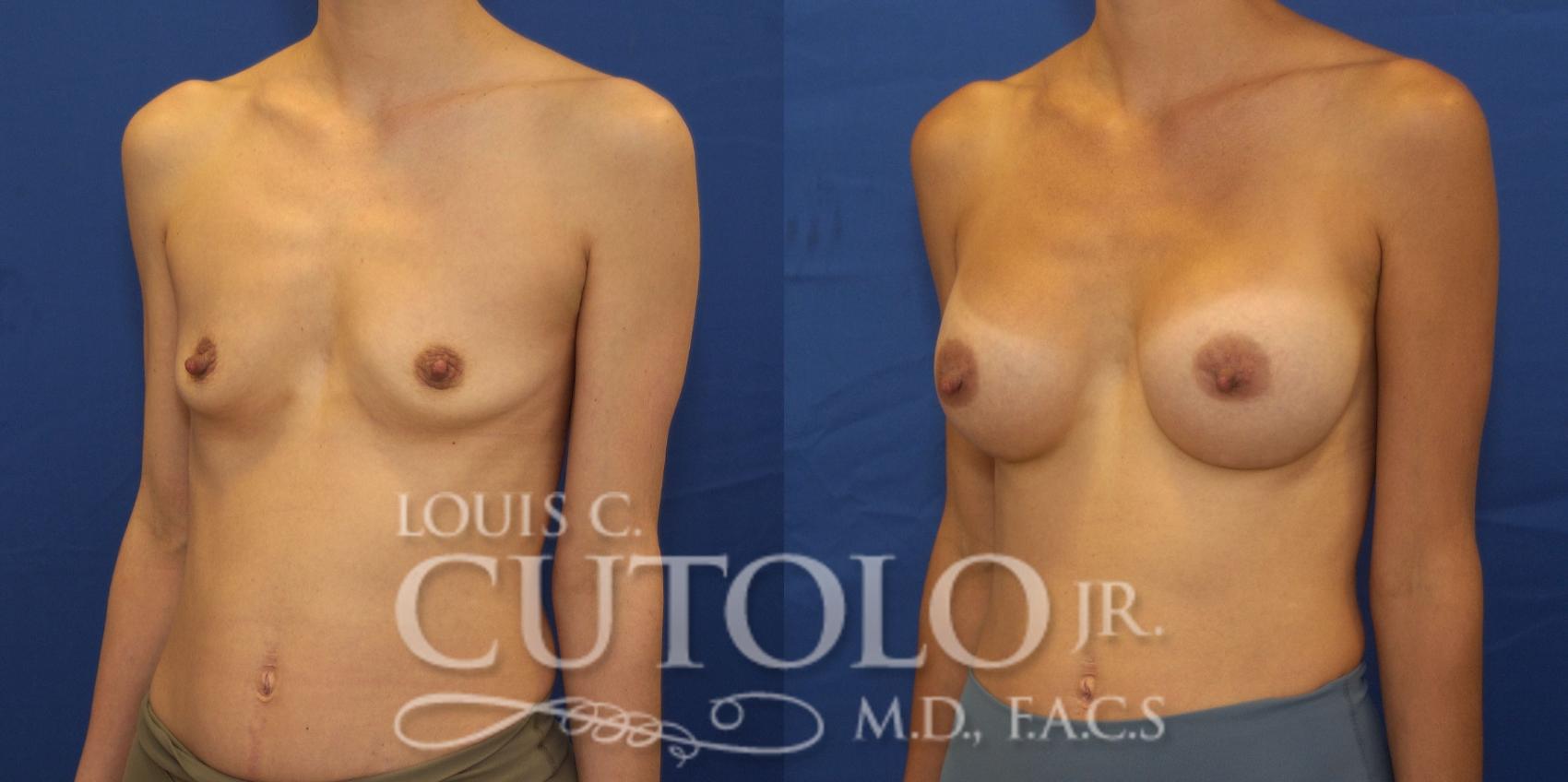 Left Oblique before