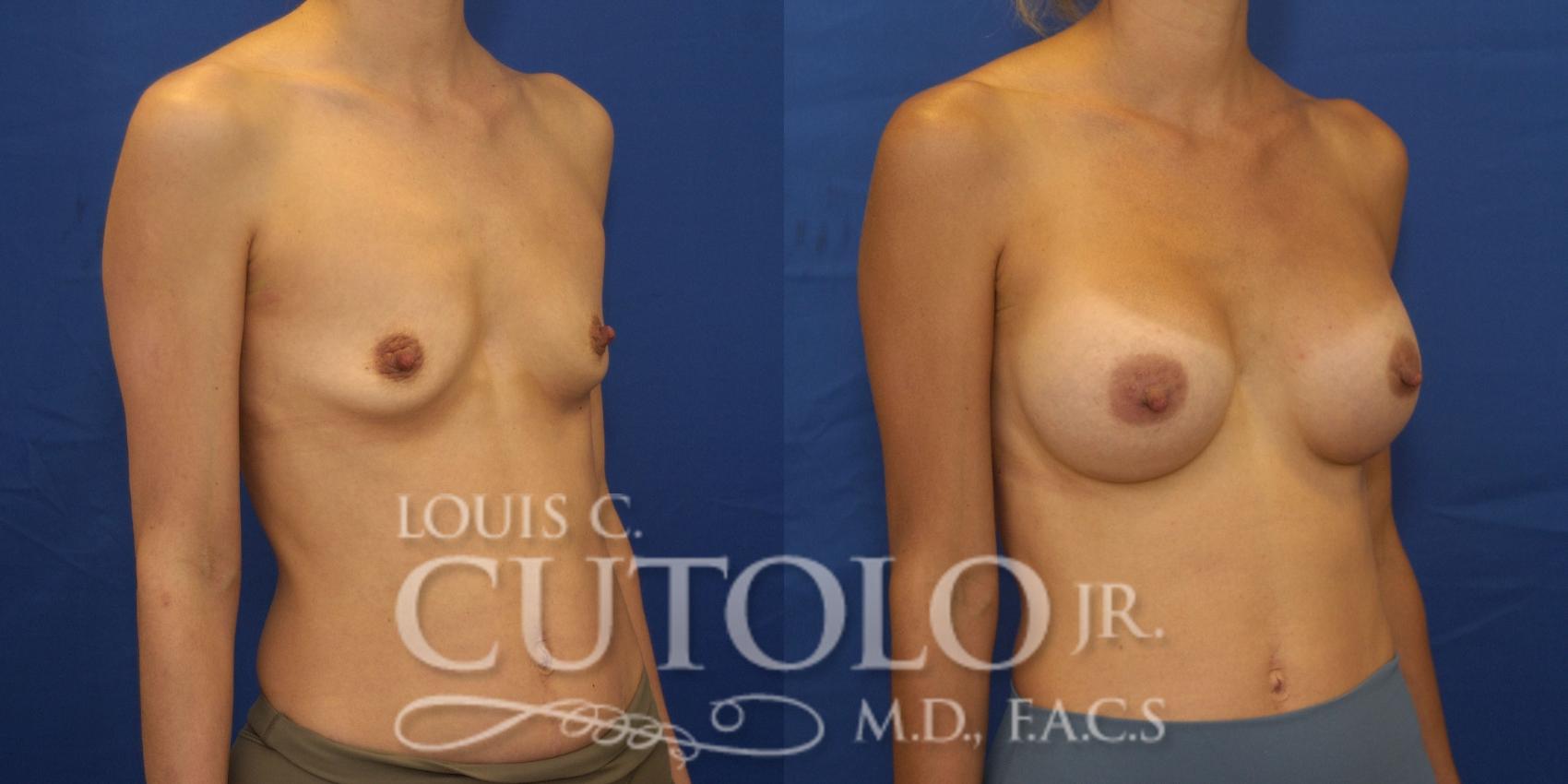Right Oblique Before