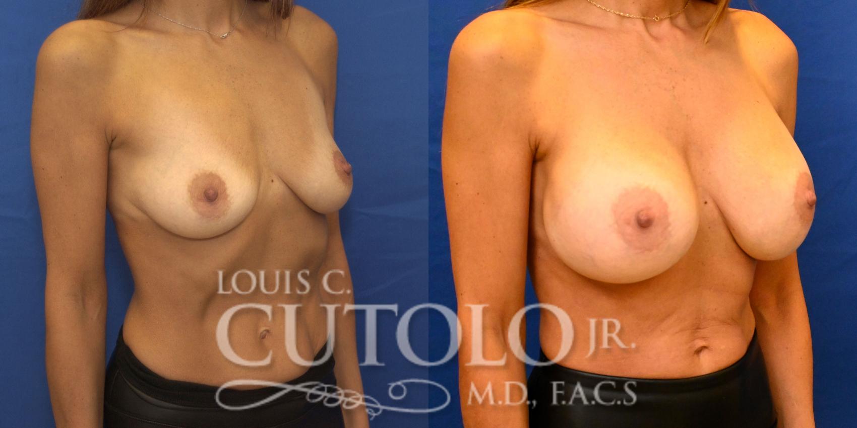 Right Oblique Before