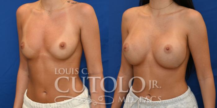 Left Oblique before