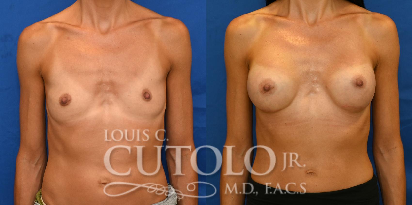 Anterior before