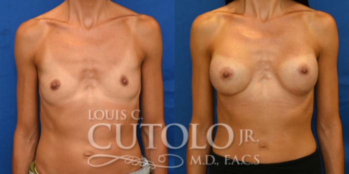 Anterior before