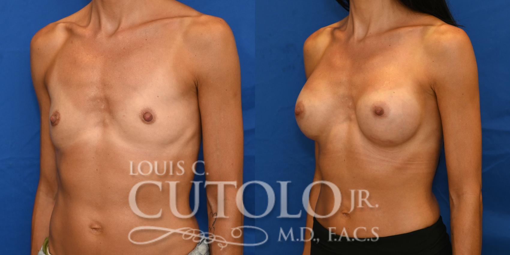 Left Oblique before