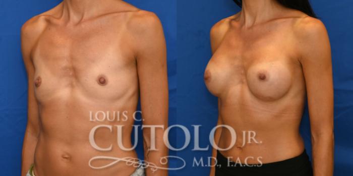 Left Oblique before