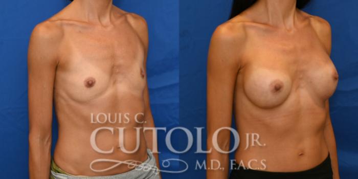 Right Oblique Before