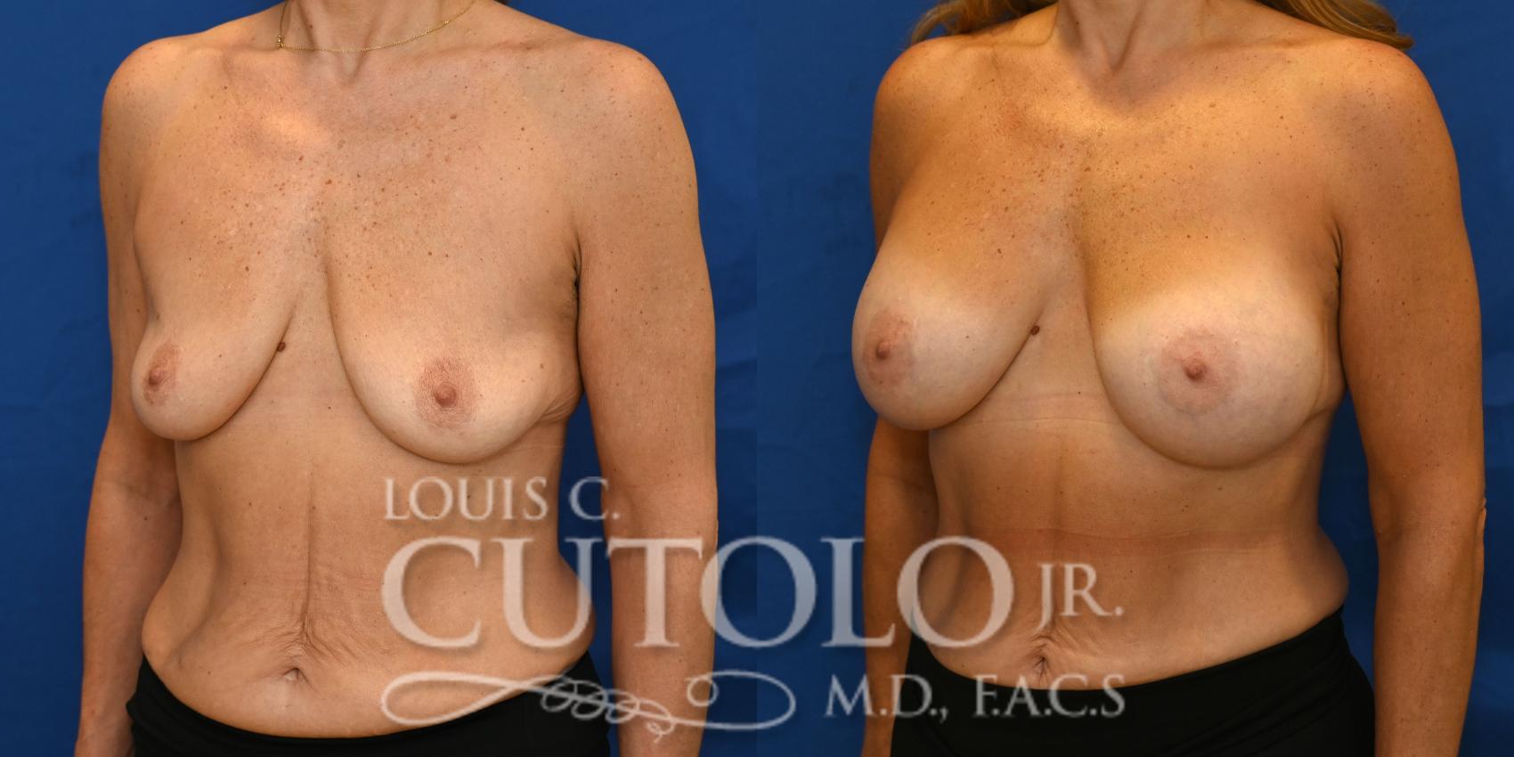 Left Oblique before