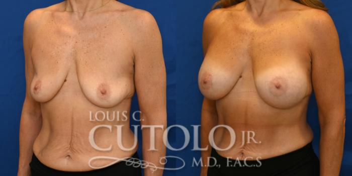 Left Oblique before