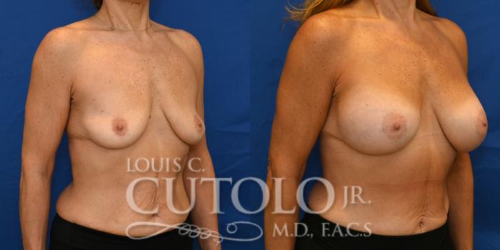 Right Oblique Before