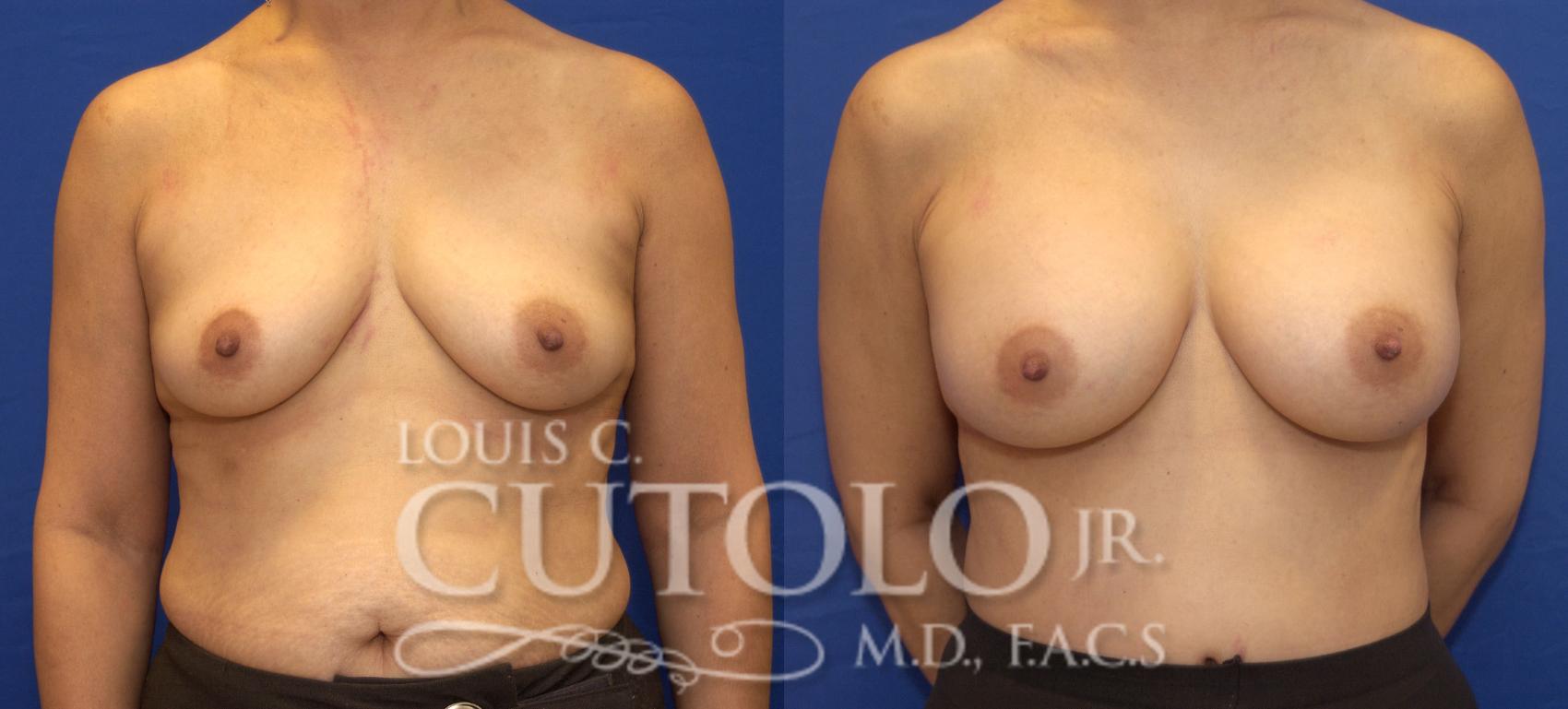 Before & After Breast Augmentation Case 27 View #1 View in Brooklyn, Staten Island, Queens, NY