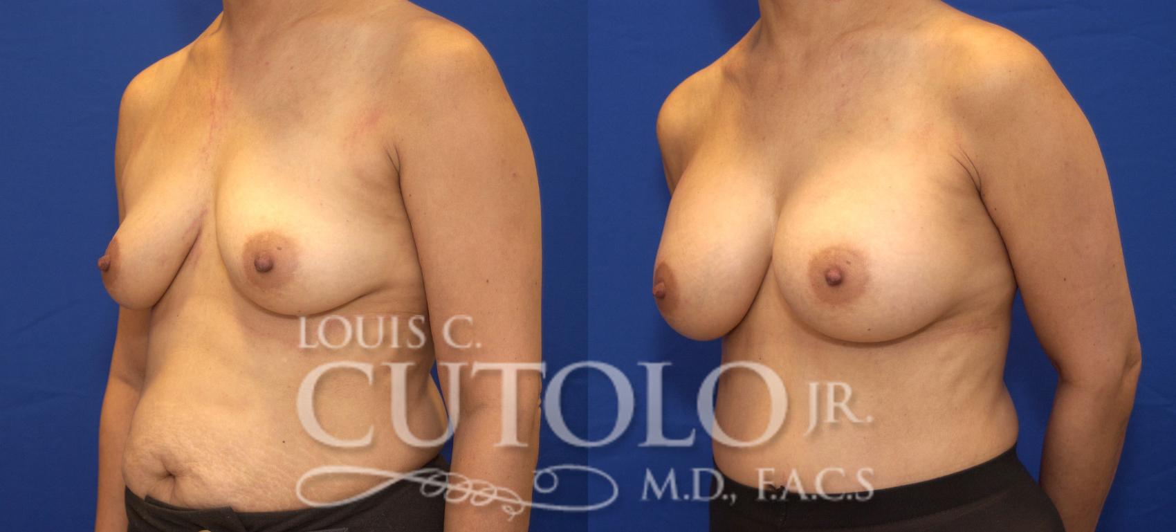 Before & After Breast Augmentation Case 27 View #2 View in Brooklyn, Staten Island, Queens, NY