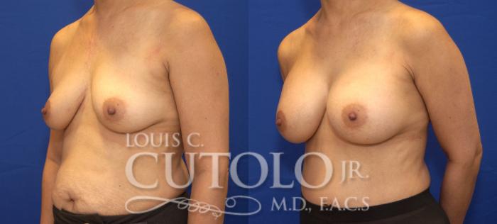 Before & After Breast Augmentation Case 27 View #2 View in Brooklyn, Staten Island, Queens, NY