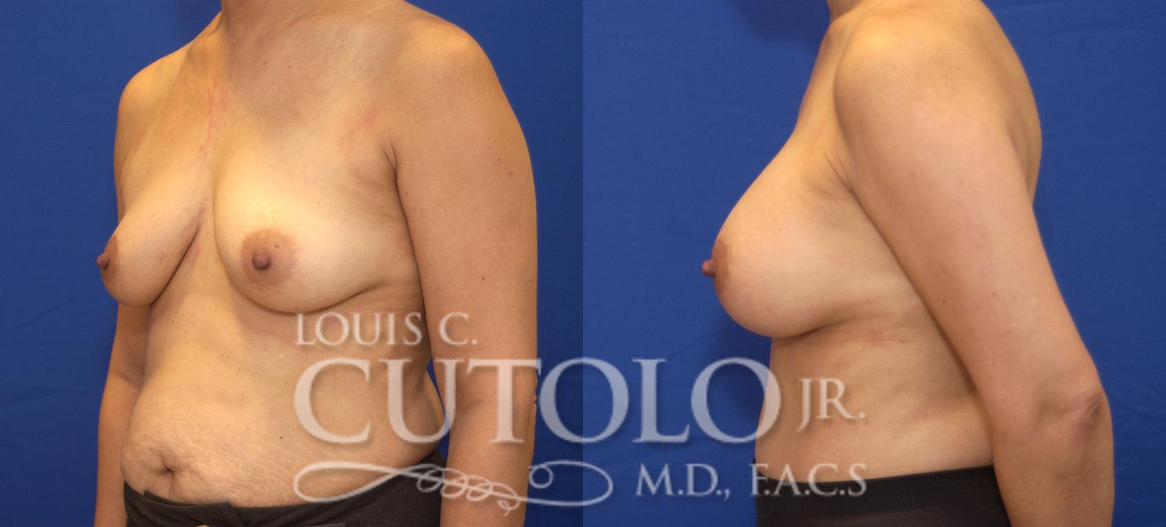 Before & After Breast Augmentation Case 27 View #3 View in Brooklyn, Staten Island, Queens, NY