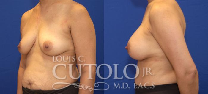 Before & After Breast Augmentation Case 27 View #3 View in Brooklyn, Staten Island, Queens, NY