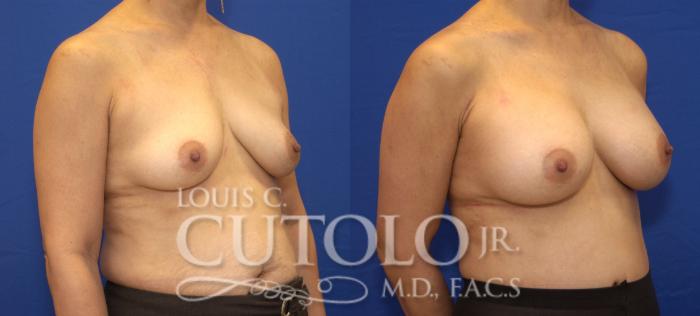 Before & After Breast Augmentation Case 27 View #4 View in Brooklyn, Staten Island, Queens, NY