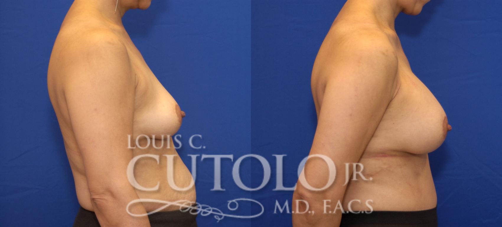 Before & After Breast Augmentation Case 27 View #5 View in Brooklyn, Staten Island, Queens, NY