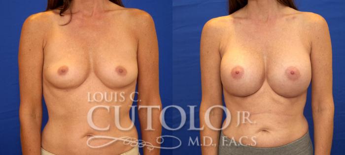 Before & After Breast Augmentation Case 29 View #1 View in Brooklyn, Staten Island, Queens, NY