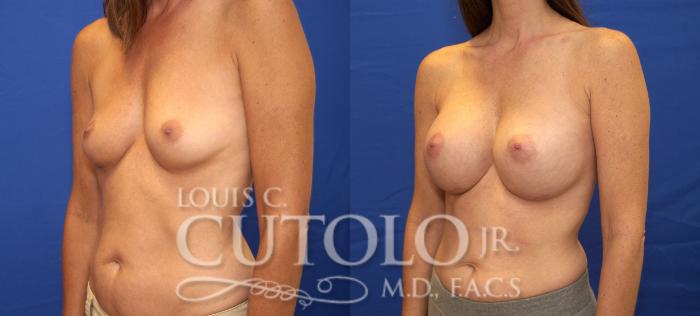 Before & After Breast Augmentation Case 29 View #2 View in Brooklyn, Staten Island, Queens, NY