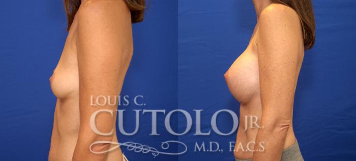 Before & After Breast Augmentation Case 29 View #3 View in Brooklyn, Staten Island, Queens, NY