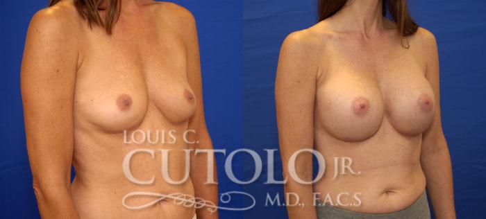 Before & After Breast Augmentation Case 29 View #4 View in Brooklyn, Staten Island, Queens, NY