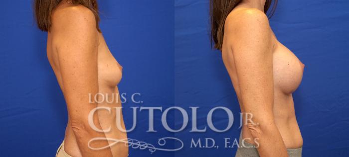 Before & After Breast Augmentation Case 29 View #5 View in Brooklyn, Staten Island, Queens, NY