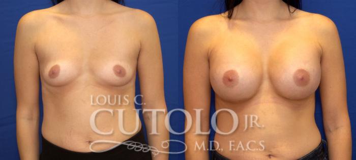 Before & After Breast Augmentation Case 31 View #1 View in Brooklyn, Staten Island, Queens, NY