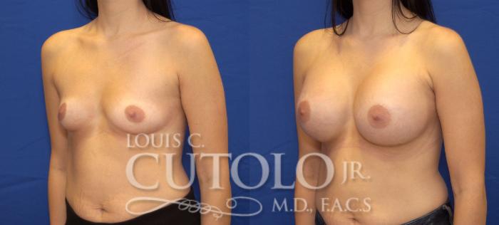 Before & After Breast Augmentation Case 31 View #2 View in Brooklyn, Staten Island, Queens, NY
