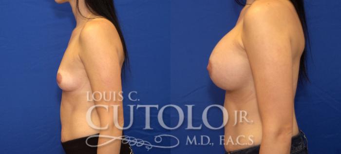Before & After Breast Augmentation Case 31 View #3 View in Brooklyn, Staten Island, Queens, NY