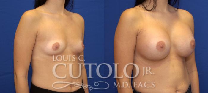 Before & After Breast Augmentation Case 31 View #4 View in Brooklyn, Staten Island, Queens, NY