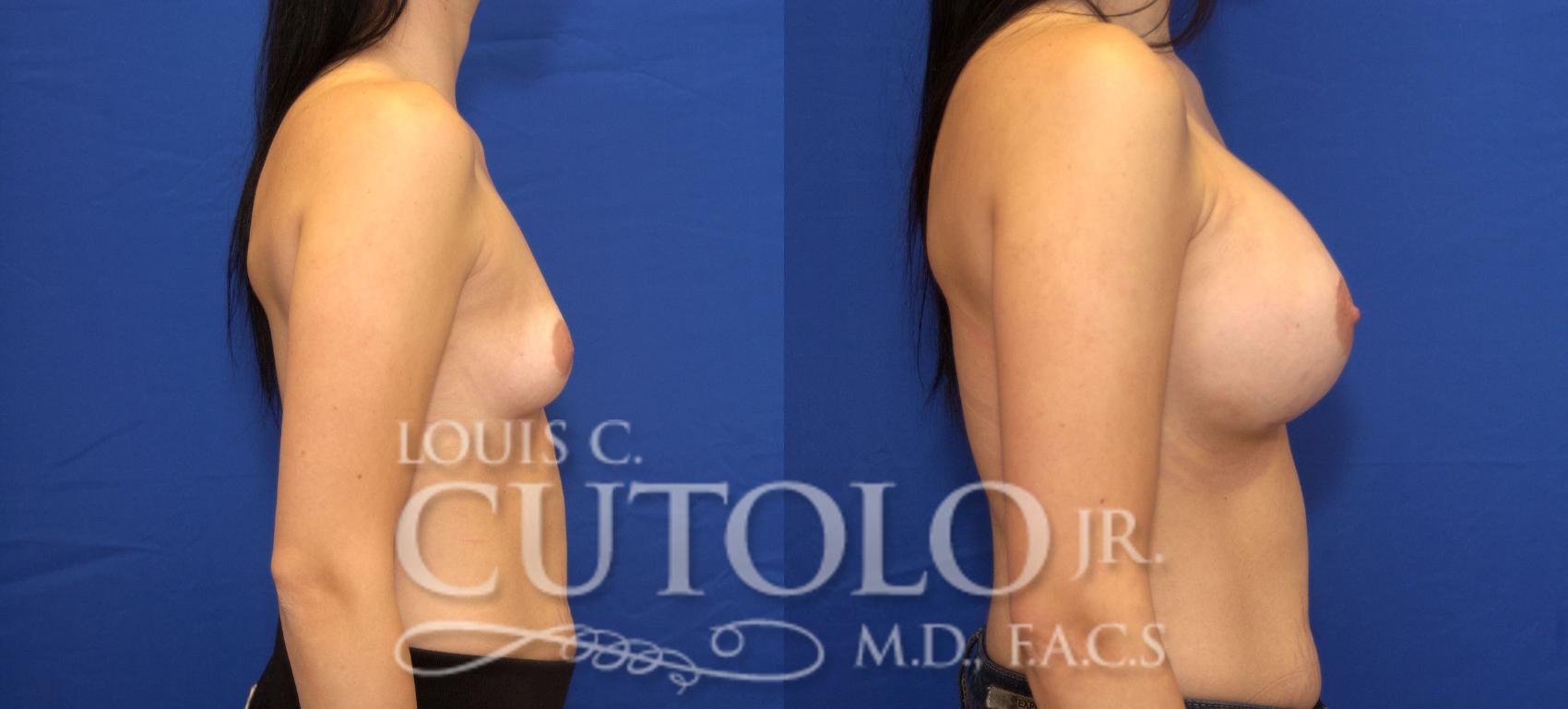 Before & After Breast Augmentation Case 31 View #5 View in Brooklyn, Staten Island, Queens, NY