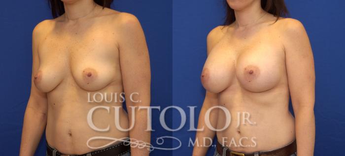 Before & After Breast Augmentation Case 34 View #2 View in Brooklyn, Staten Island, Queens, NY