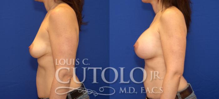 Before & After Breast Augmentation Case 34 View #3 View in Brooklyn, Staten Island, Queens, NY