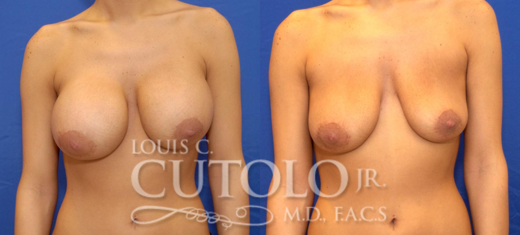 Before & After Breast Augmentation Case 35 View #1 View in Brooklyn, Staten Island, Queens, NY