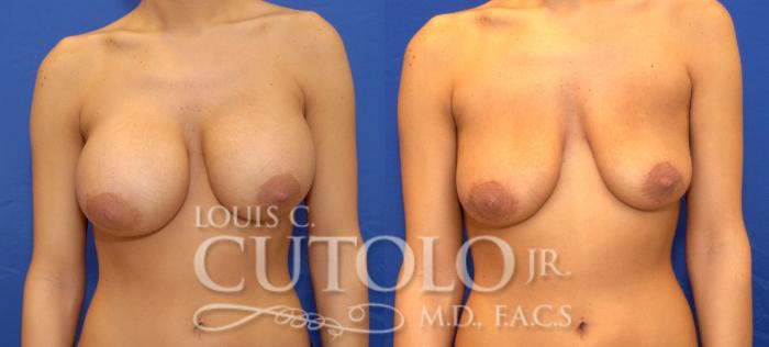 Before & After Breast Augmentation Case 35 View #1 View in Brooklyn, Staten Island, Queens, NY