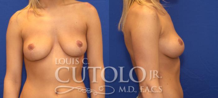 Before & After Breast Augmentation Case 35 View #2 View in Brooklyn, Staten Island, Queens, NY
