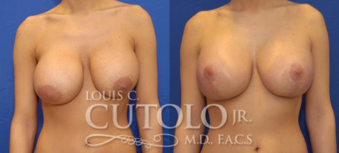 Before & After Breast Augmentation Case 35 View #3 View in Brooklyn, Staten Island, Queens, NY