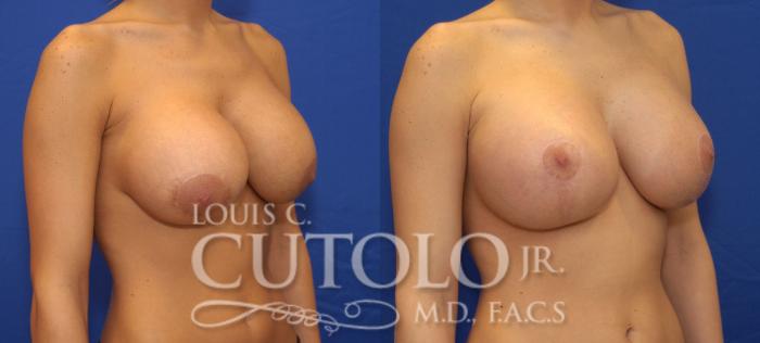 Before & After Breast Augmentation Case 35 View #4 View in Brooklyn, Staten Island, Queens, NY