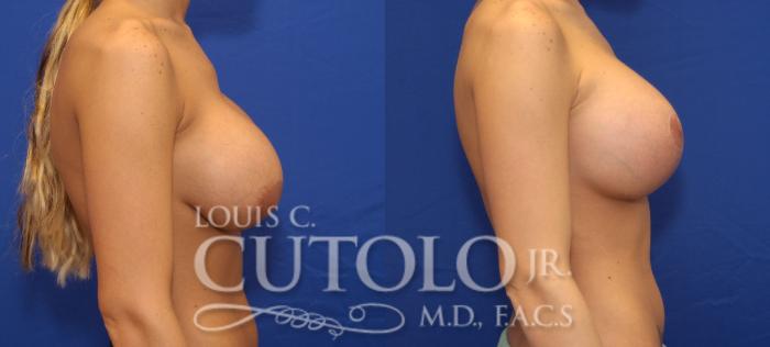 Before & After Breast Augmentation Case 35 View #5 View in Brooklyn, Staten Island, Queens, NY