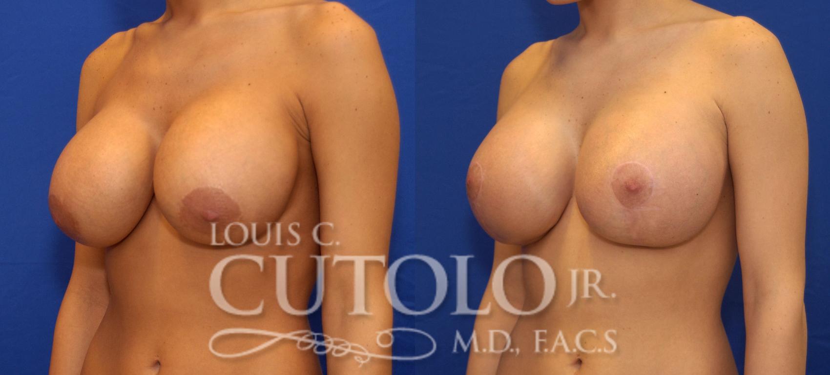 Before & After Breast Augmentation Case 35 View #6 View in Brooklyn, Staten Island, Queens, NY